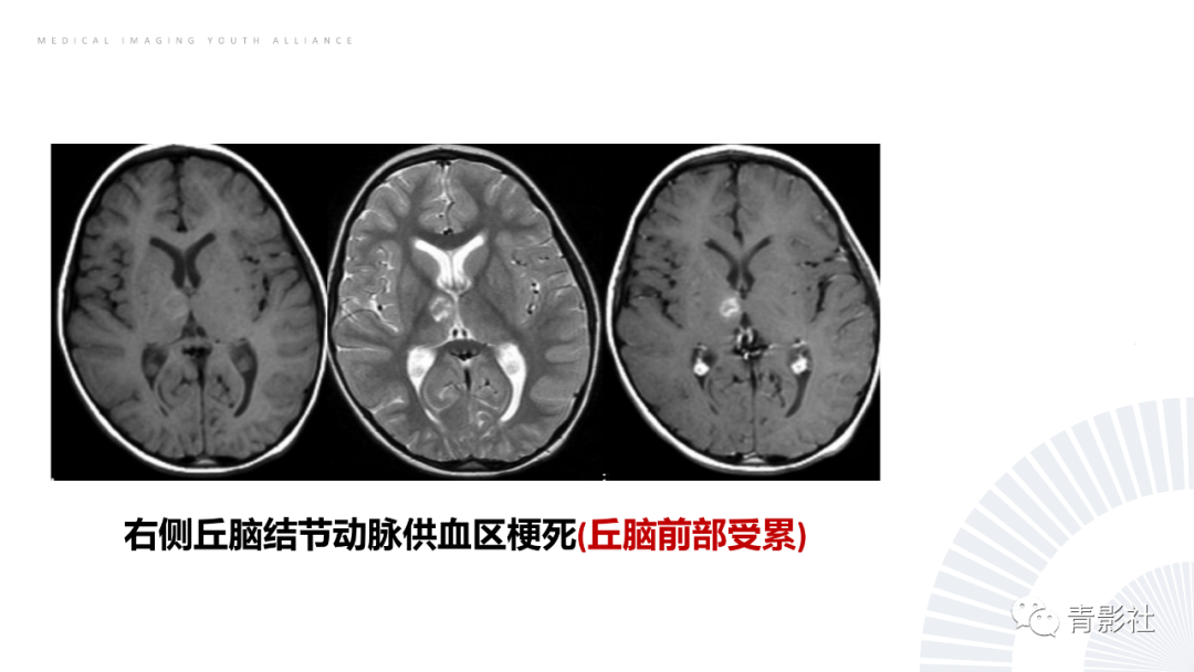 影像PPT - 【PPT】丘脑解剖及常见病变的影像学诊断-30