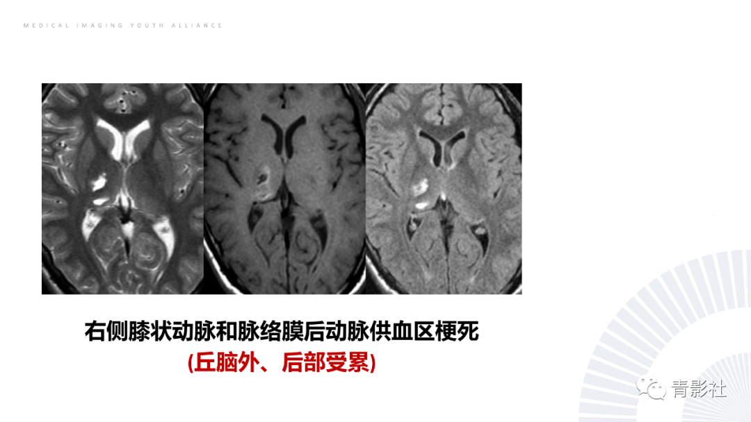 影像PPT - 【PPT】丘脑解剖及常见病变的影像学诊断-31
