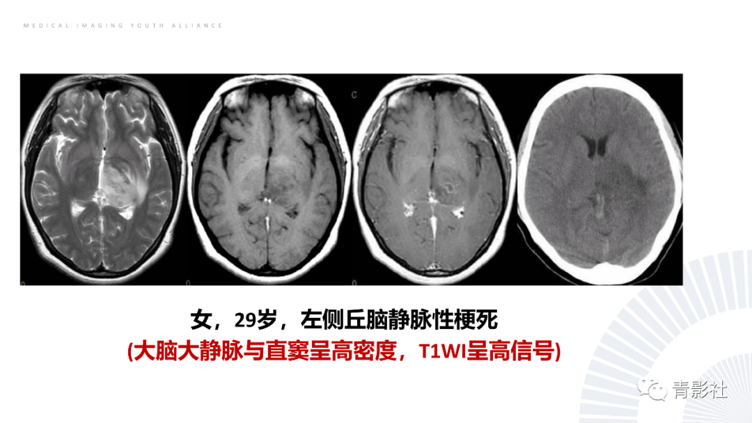 影像PPT - 【PPT】丘脑解剖及常见病变的影像学诊断-33