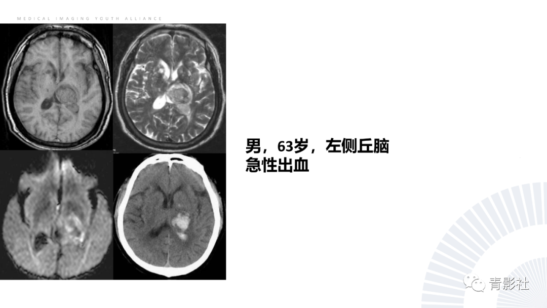 影像PPT - 【PPT】丘脑解剖及常见病变的影像学诊断-35