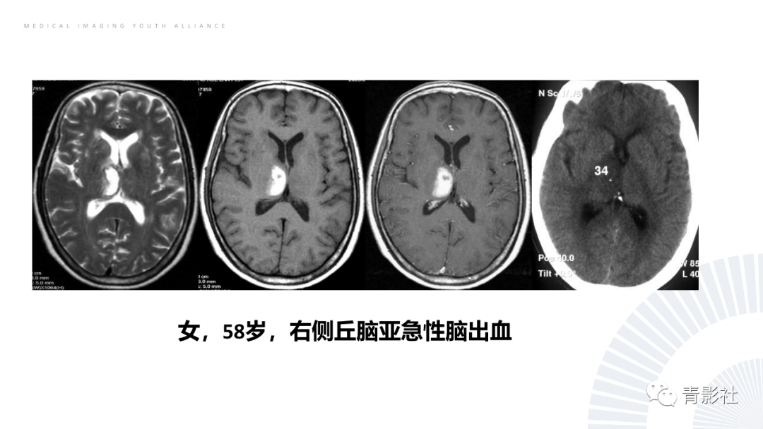 影像PPT - 【PPT】丘脑解剖及常见病变的影像学诊断-36