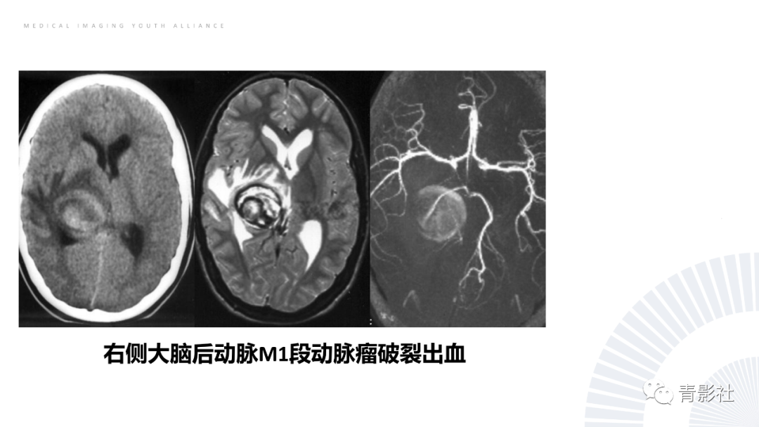 影像PPT - 【PPT】丘脑解剖及常见病变的影像学诊断-38
