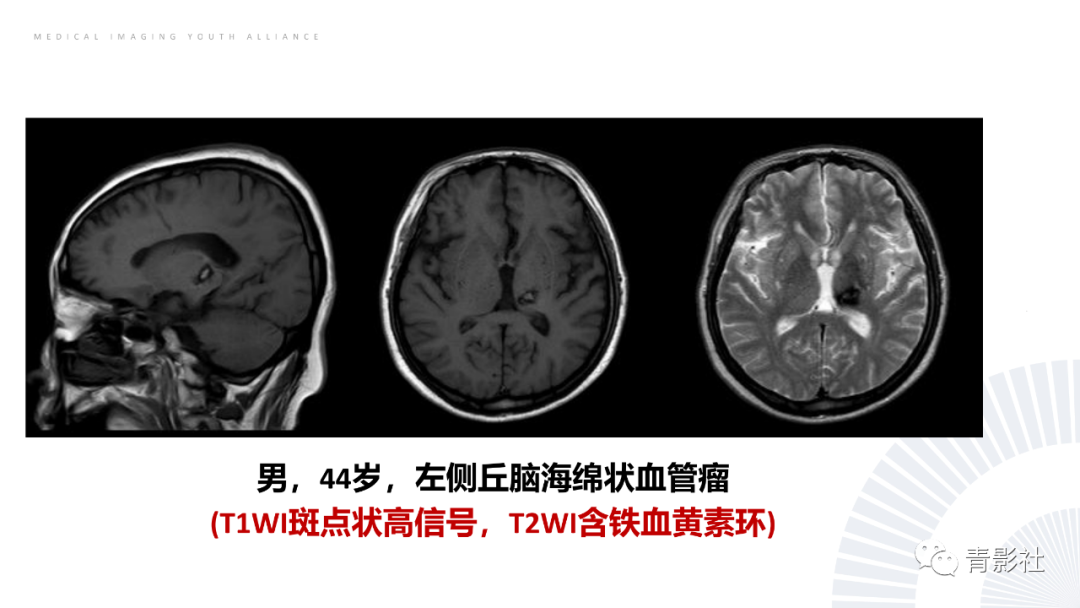 影像PPT - 【PPT】丘脑解剖及常见病变的影像学诊断-39