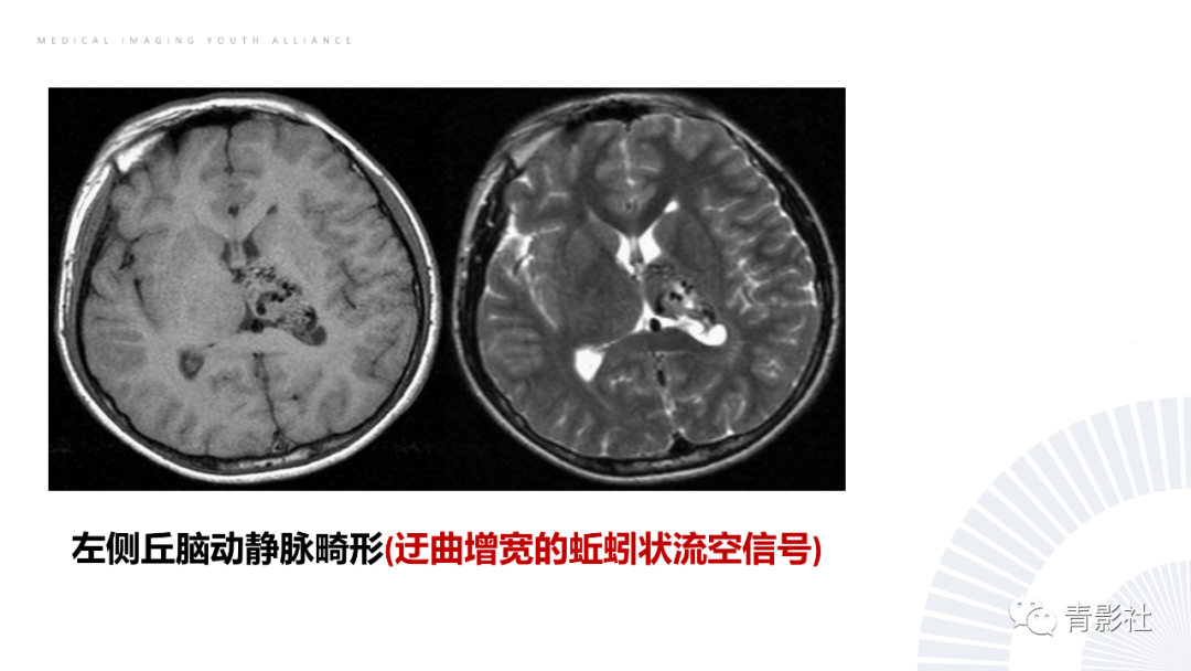 影像PPT - 【PPT】丘脑解剖及常见病变的影像学诊断-40