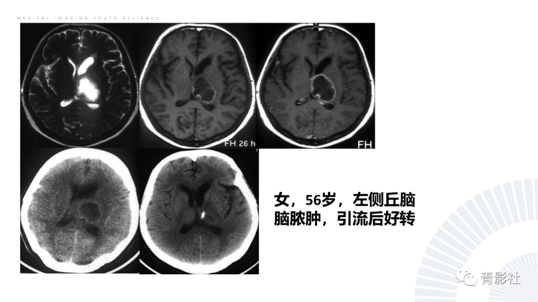 影像PPT - 【PPT】丘脑解剖及常见病变的影像学诊断-42
