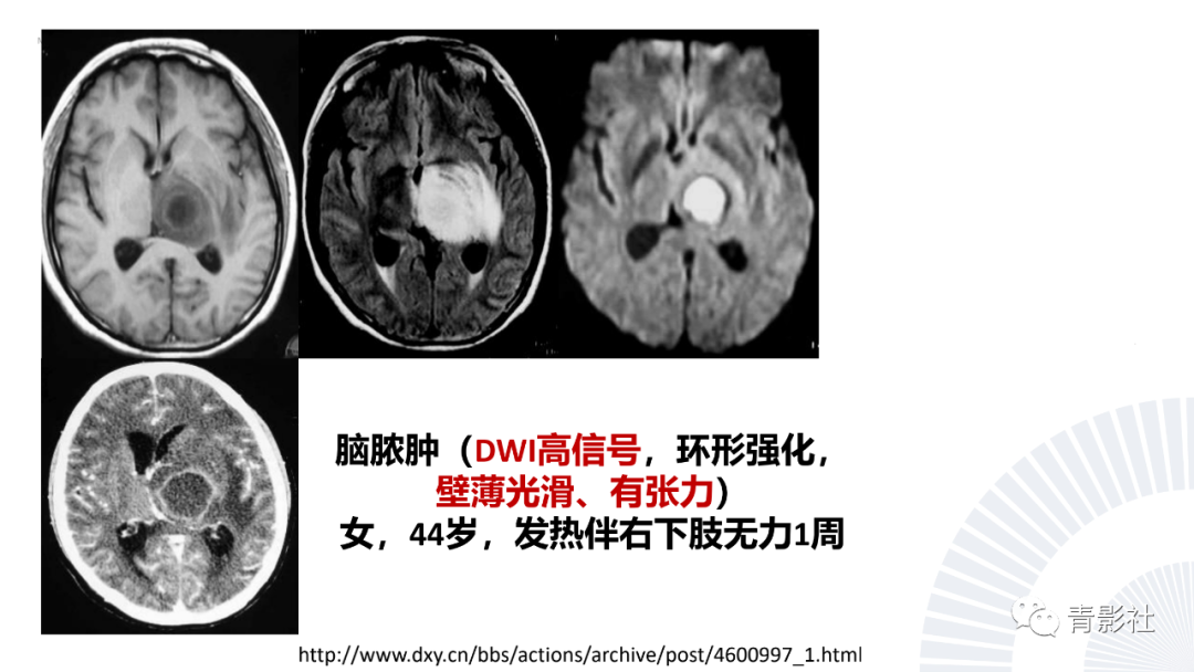 影像PPT - 【PPT】丘脑解剖及常见病变的影像学诊断-43