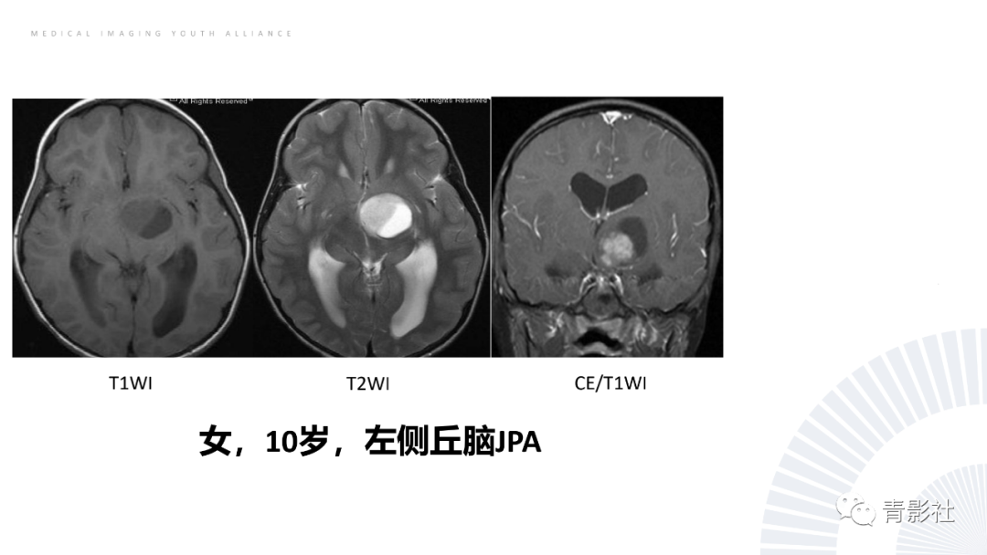 影像PPT - 【PPT】丘脑解剖及常见病变的影像学诊断-45