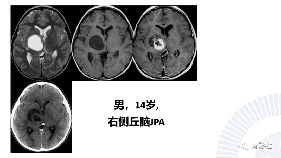 影像PPT - 【PPT】丘脑解剖及常见病变的影像学诊断-46