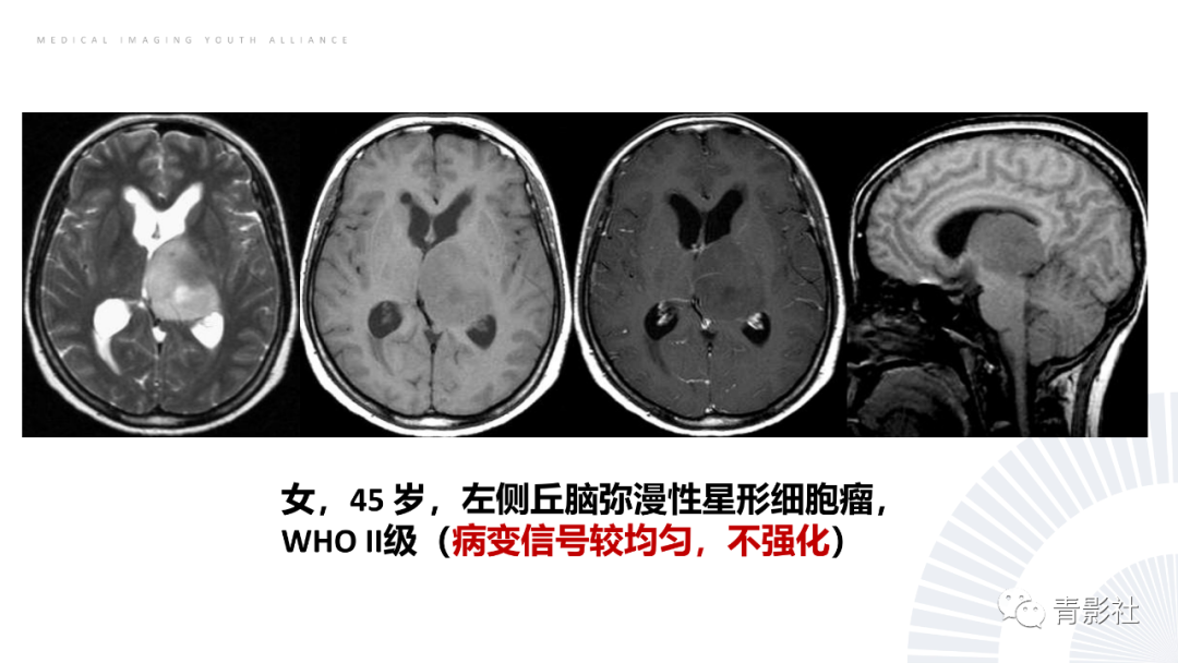 影像PPT - 【PPT】丘脑解剖及常见病变的影像学诊断-48
