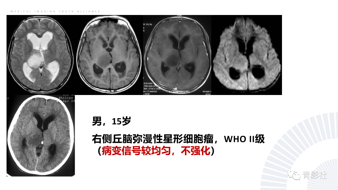 影像PPT - 【PPT】丘脑解剖及常见病变的影像学诊断-49