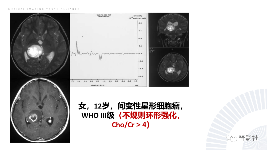 影像PPT - 【PPT】丘脑解剖及常见病变的影像学诊断-51