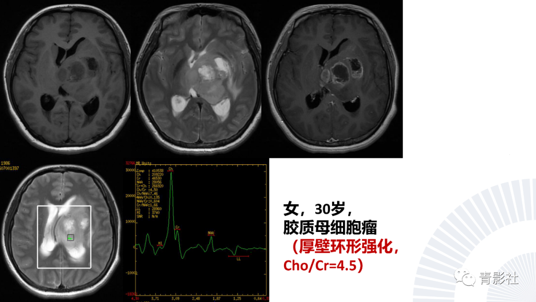影像PPT - 【PPT】丘脑解剖及常见病变的影像学诊断-54