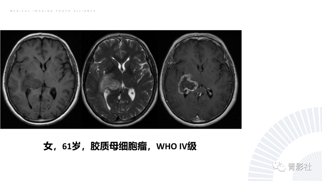 影像PPT - 【PPT】丘脑解剖及常见病变的影像学诊断-55