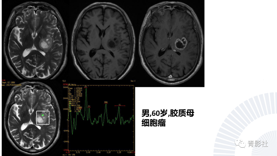 影像PPT - 【PPT】丘脑解剖及常见病变的影像学诊断-56