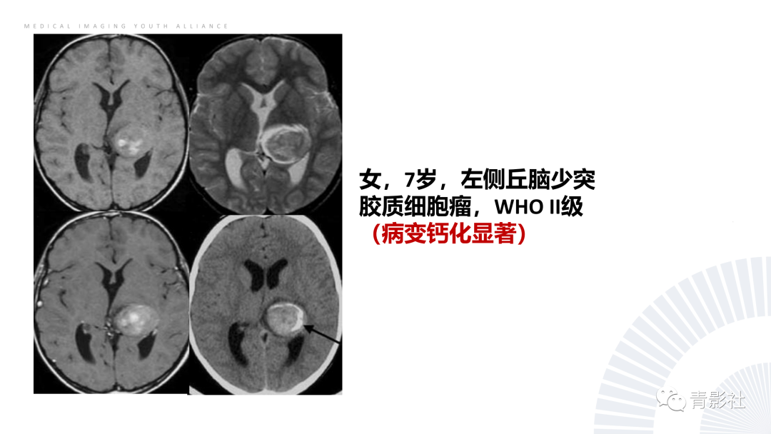影像PPT - 【PPT】丘脑解剖及常见病变的影像学诊断-58
