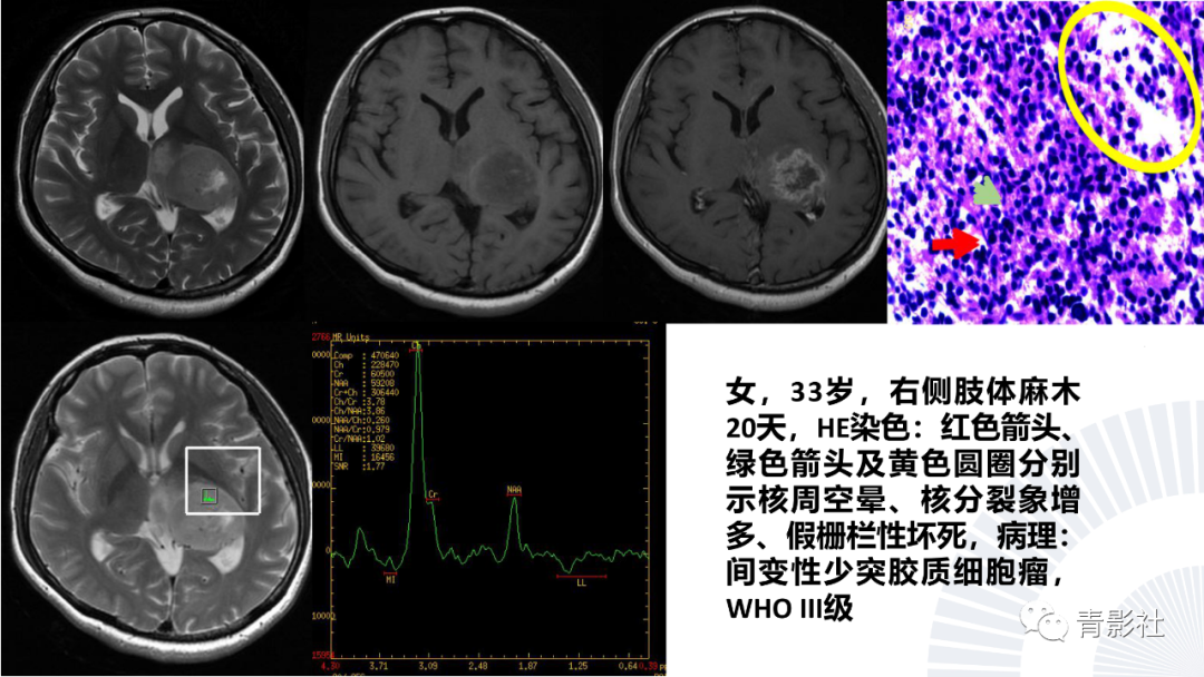 影像PPT - 【PPT】丘脑解剖及常见病变的影像学诊断-59