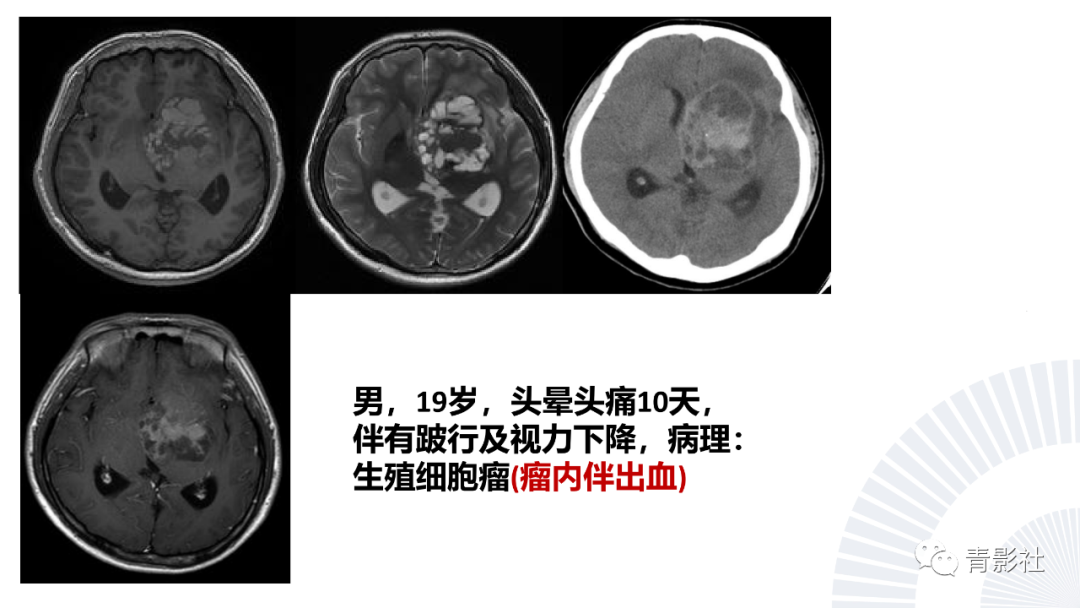 影像PPT - 【PPT】丘脑解剖及常见病变的影像学诊断-61