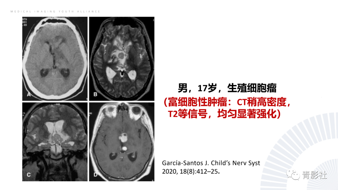 影像PPT - 【PPT】丘脑解剖及常见病变的影像学诊断-62