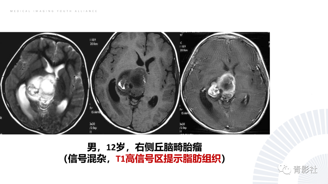 影像PPT - 【PPT】丘脑解剖及常见病变的影像学诊断-64