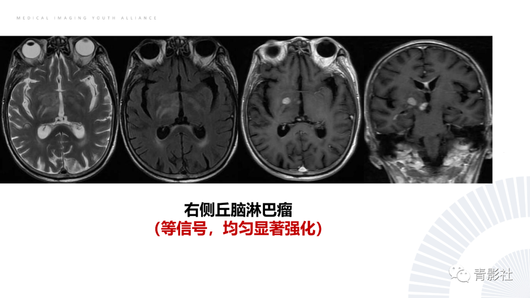 影像PPT - 【PPT】丘脑解剖及常见病变的影像学诊断-66