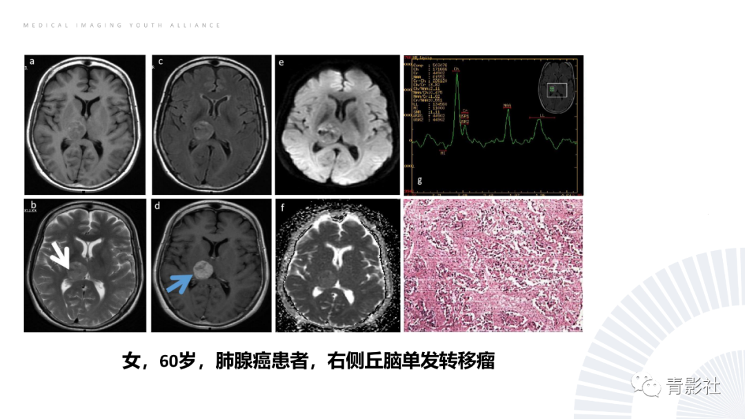 影像PPT - 【PPT】丘脑解剖及常见病变的影像学诊断-69