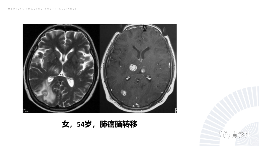 影像PPT - 【PPT】丘脑解剖及常见病变的影像学诊断-70