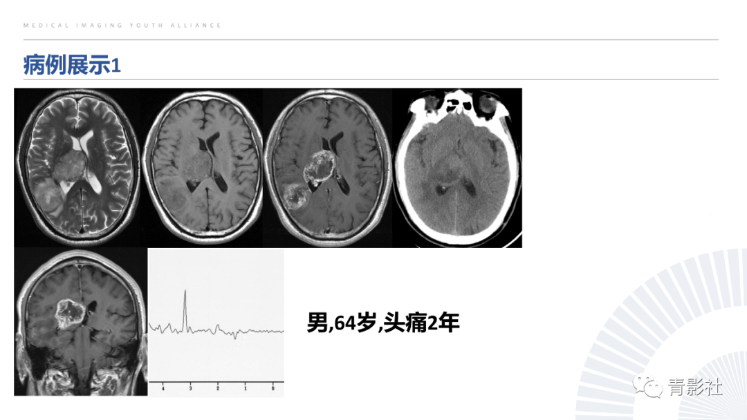 影像PPT - 【PPT】丘脑解剖及常见病变的影像学诊断-72