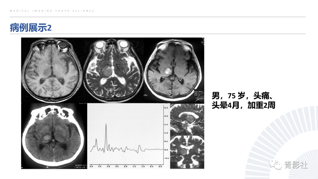 影像PPT - 【PPT】丘脑解剖及常见病变的影像学诊断-75
