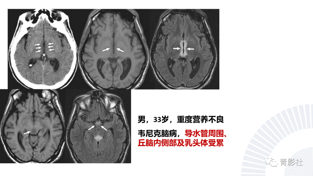 影像PPT - 【PPT】丘脑解剖及常见病变的影像学诊断-3