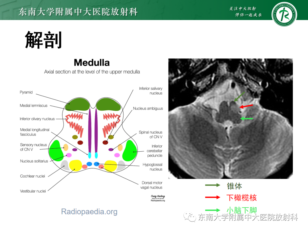 影像PPT - 【PPT】肥大性下橄榄核变性-7