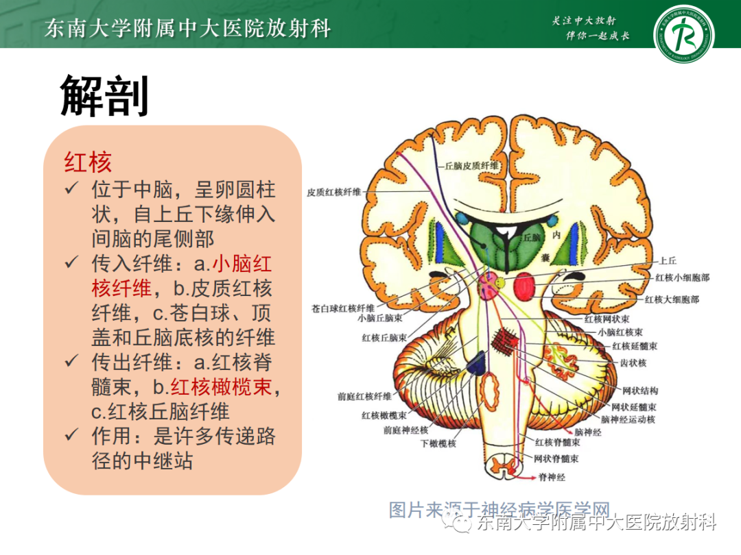 影像PPT - 【PPT】肥大性下橄榄核变性-8
