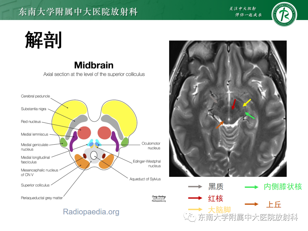 影像PPT - 【PPT】肥大性下橄榄核变性-9