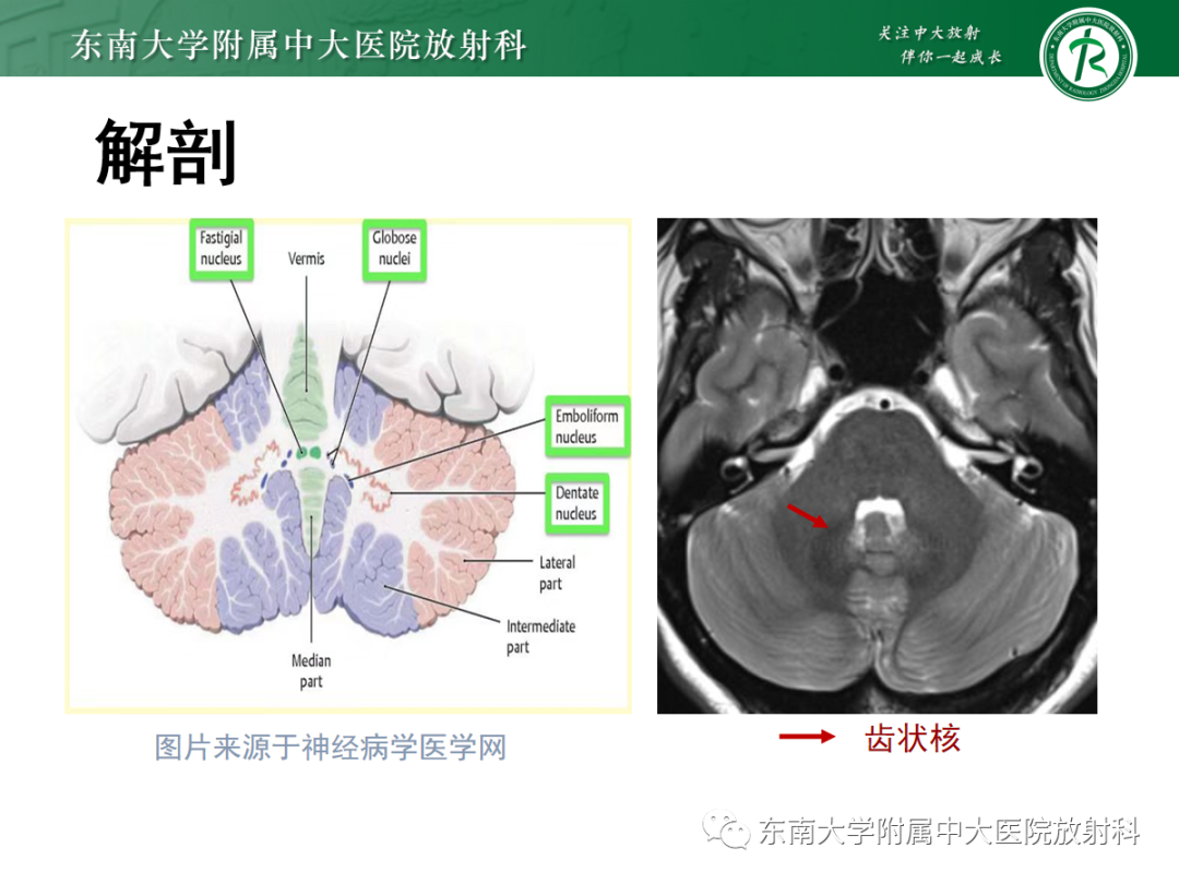 影像PPT - 【PPT】肥大性下橄榄核变性-11