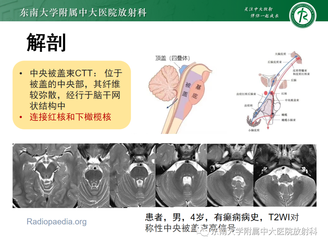影像PPT - 【PPT】肥大性下橄榄核变性-12