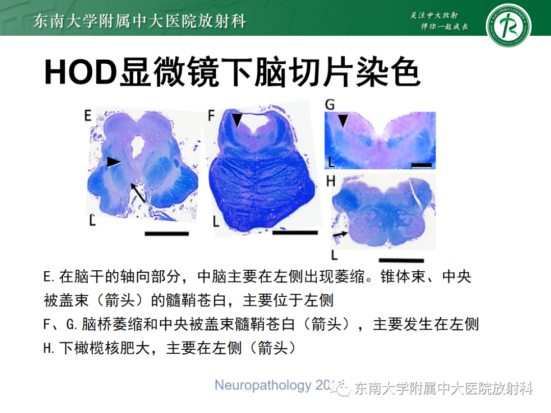 影像PPT - 【PPT】肥大性下橄榄核变性-19
