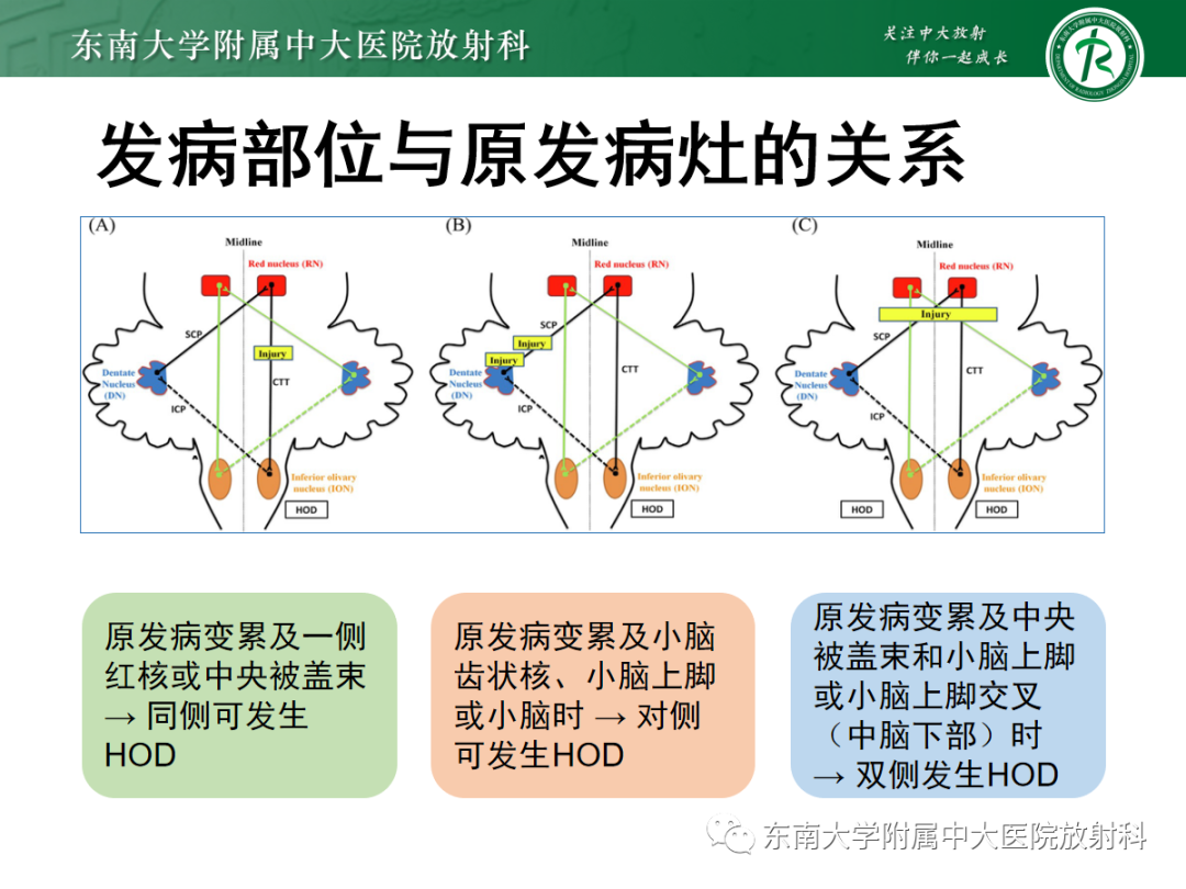 影像PPT - 【PPT】肥大性下橄榄核变性-25