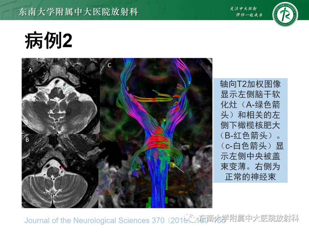 影像PPT - 【PPT】肥大性下橄榄核变性-24