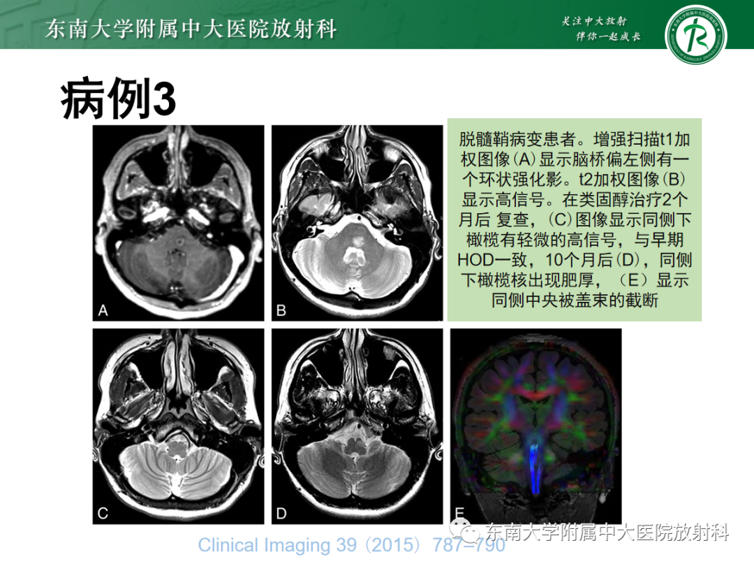 影像PPT - 【PPT】肥大性下橄榄核变性-26