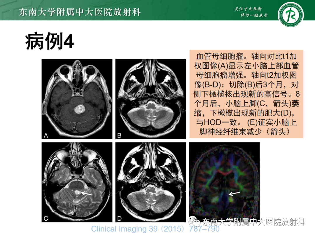 影像PPT - 【PPT】肥大性下橄榄核变性-27