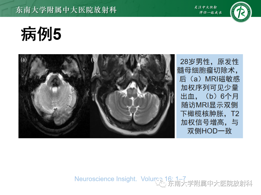 影像PPT - 【PPT】肥大性下橄榄核变性-28