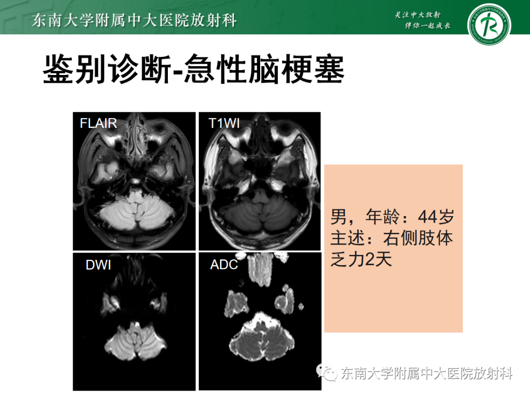 影像PPT - 【PPT】肥大性下橄榄核变性-31