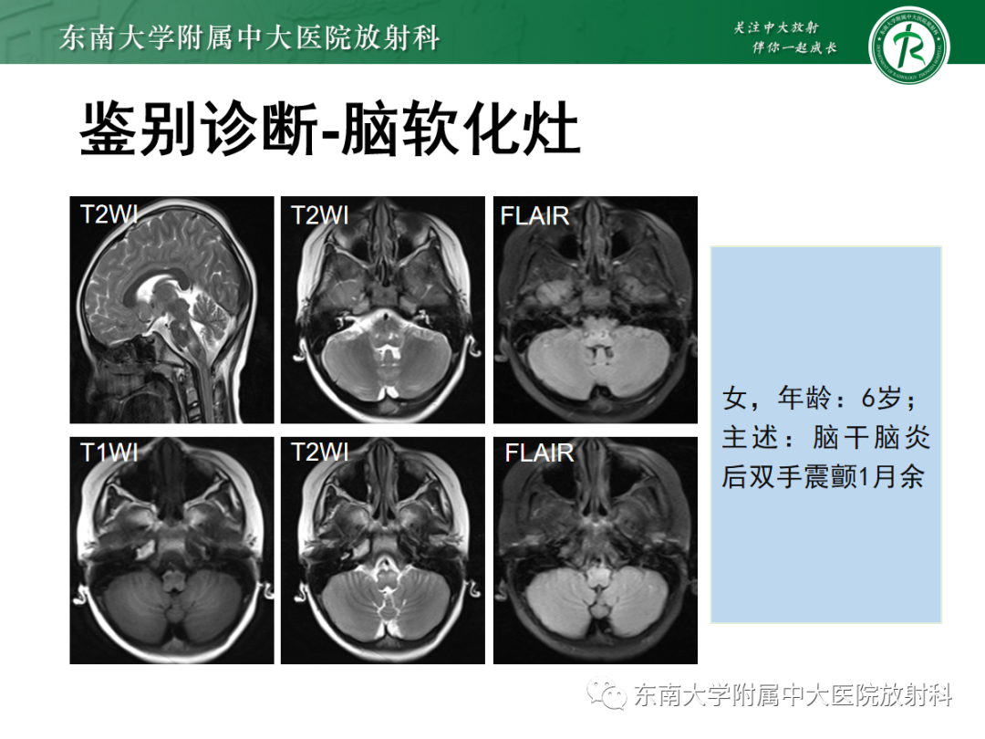 影像PPT - 【PPT】肥大性下橄榄核变性-32