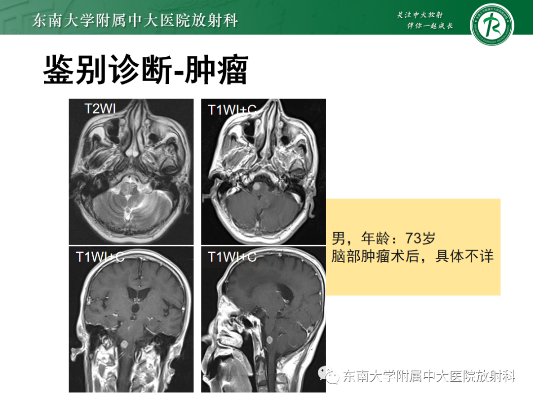 影像PPT - 【PPT】肥大性下橄榄核变性-34