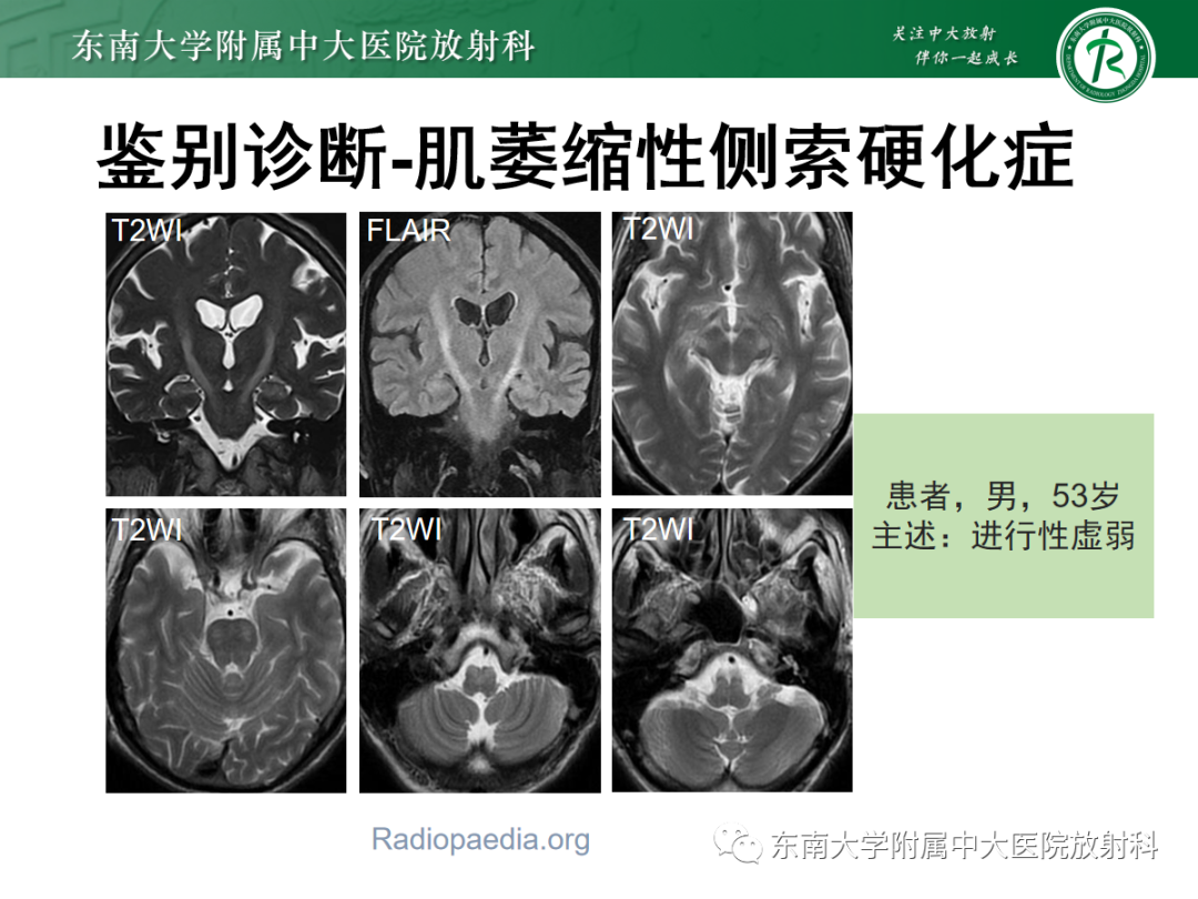 影像PPT - 【PPT】肥大性下橄榄核变性-33