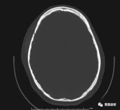影像PPT - 头部CT读片详解-2 影像PPT - 头部CT读片详解-2