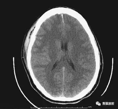 影像PPT - 头部CT读片详解-3 影像PPT - 头部CT读片详解-3