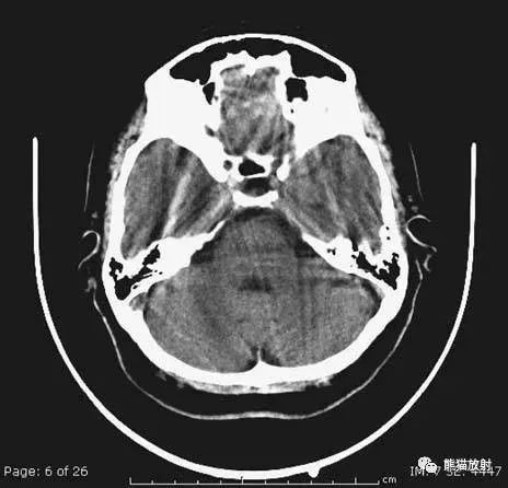 影像PPT - 头部CT读片详解-5 影像PPT - 头部CT读片详解-5