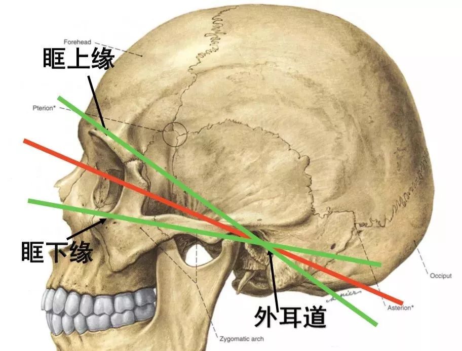 影像PPT - 头部CT读片详解-9 影像PPT - 头部CT读片详解-9