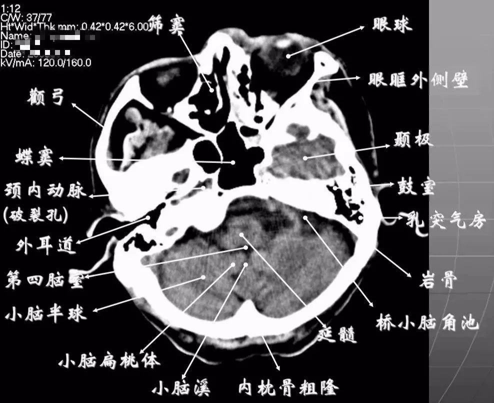 影像PPT - 头部CT读片详解-10 影像PPT - 头部CT读片详解-10