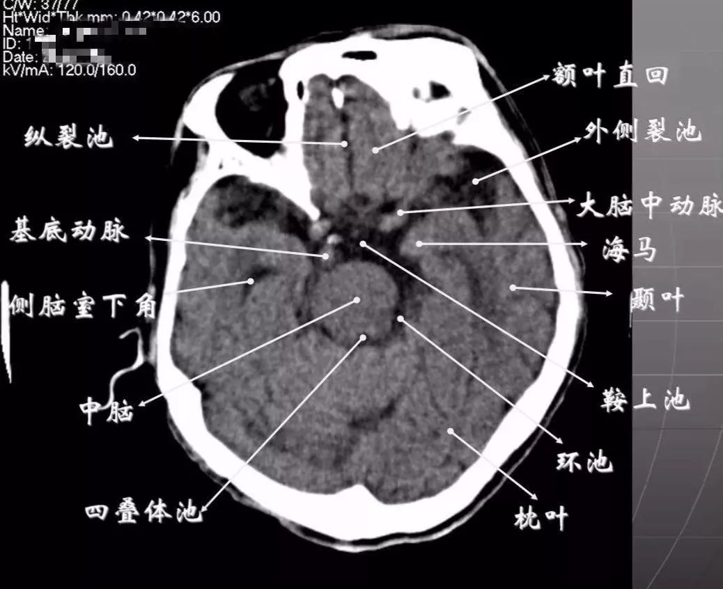 影像PPT - 头部CT读片详解-11 影像PPT - 头部CT读片详解-11
